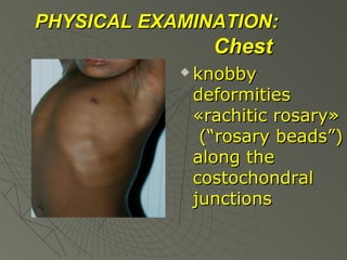 PHYSICAL EXAMINATION:

Chest


knobby
deformities
«rachitic rosary»
(“rosary beads”)
along the
costochondral
junctions

 