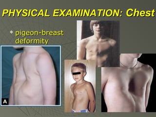 PHYSICAL EXAMINATION: Chest


pigeon-breast
deformity

 