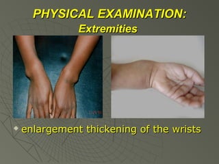 PHYSICAL EXAMINATION:
Extremities



enlargement thickening of the wrists

 