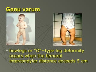 Genu varum



bowlegs or “O“−type leg deformity
occurs when the femoral
intercondylar distance exceeds 5 cm

 