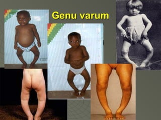 Genu varum

 