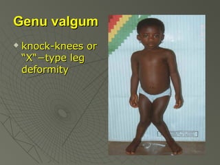 Genu valgum


knock-knees or
“X“−type leg
deformity

 