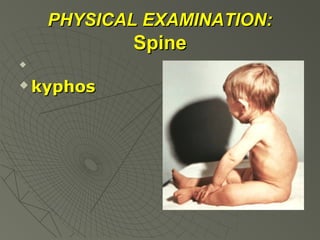PHYSICAL EXAMINATION:

Spine




kyphos

 