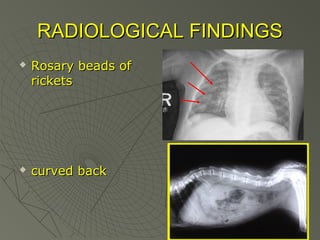 RADIOLOGICAL FINDINGS




Rosary beads of
rickets

curved back

 