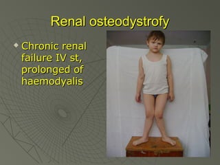 Renal osteodystrofy


Chronic renal
failure IV st,
prolonged of
haemodyalis

 