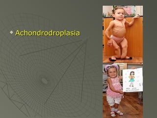 

Achondrodroplasia

 