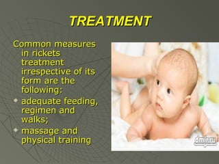 TREATMENT
Common measures
in rickets
treatment
irrespective of its
form are the
following:
 adequate feeding,
regimen and
walks;
 massage and
physical training

 