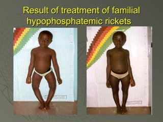 Result of treatment of familial
hypophosphatemic rickets

 