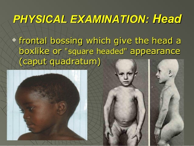Head In Rickets Rickets lecture