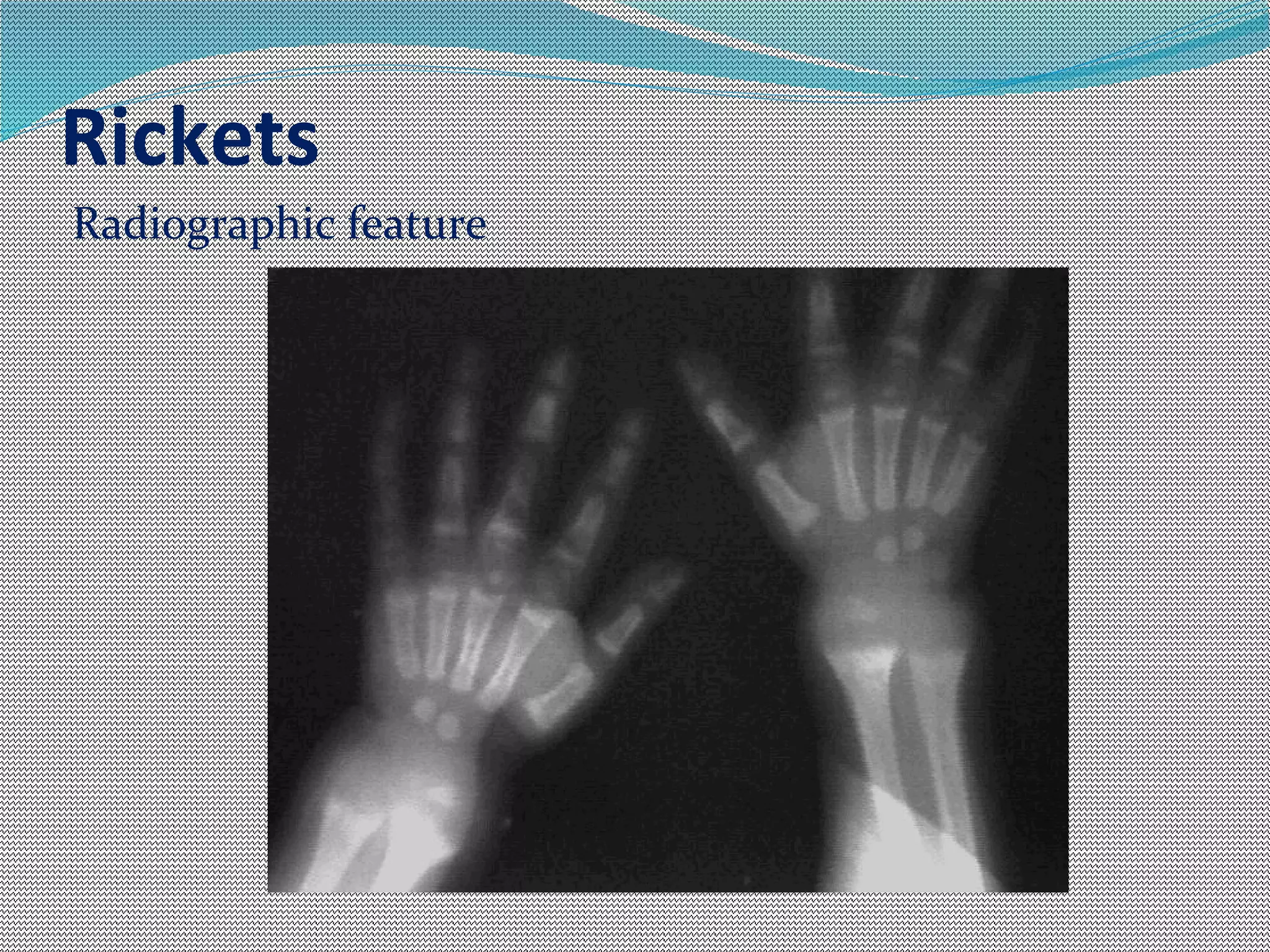Rickets & osteomalacia | PPT
