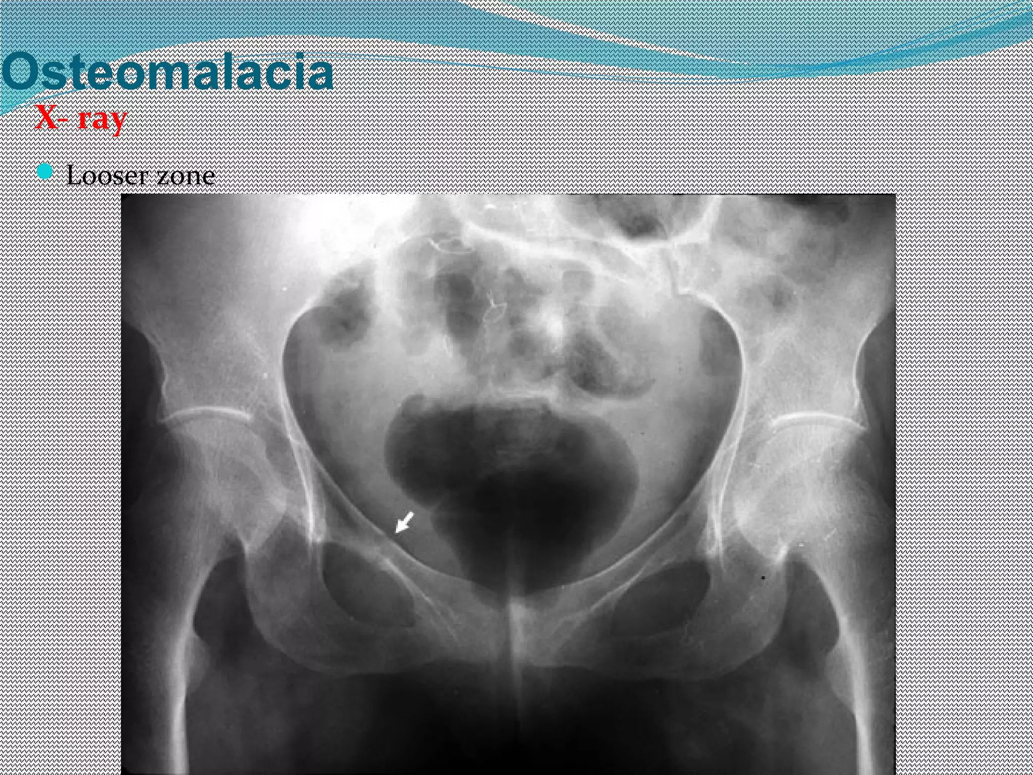 Rickets & osteomalacia | PPT