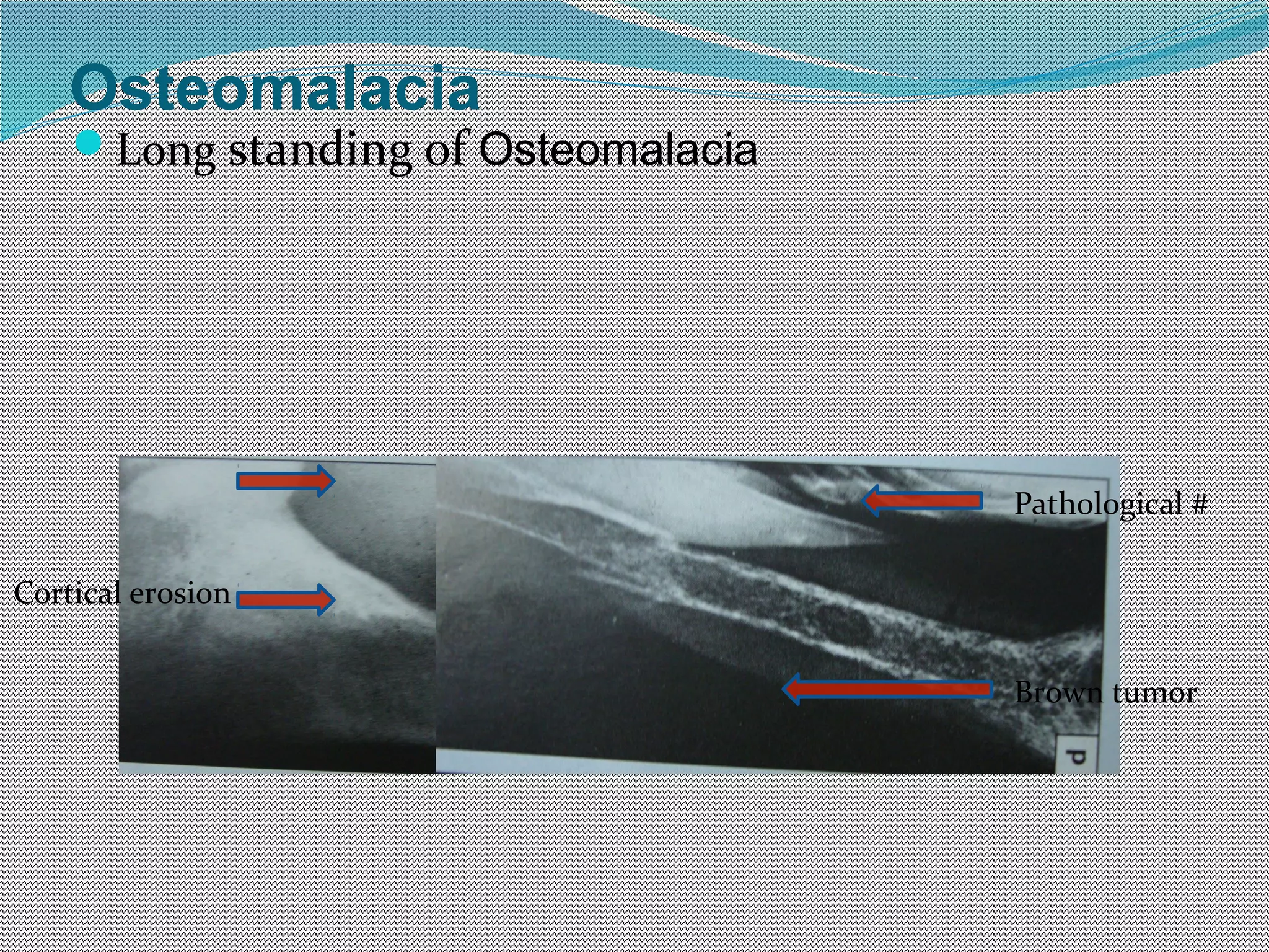 Rickets & osteomalacia | PPT