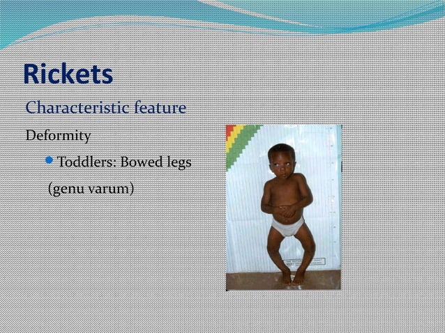 Rickets & osteomalacia | PPT