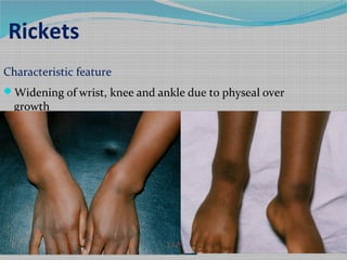 Rickets
Characteristic feature
Deformity
Older children: Knock-knees
(genu valgum)
 