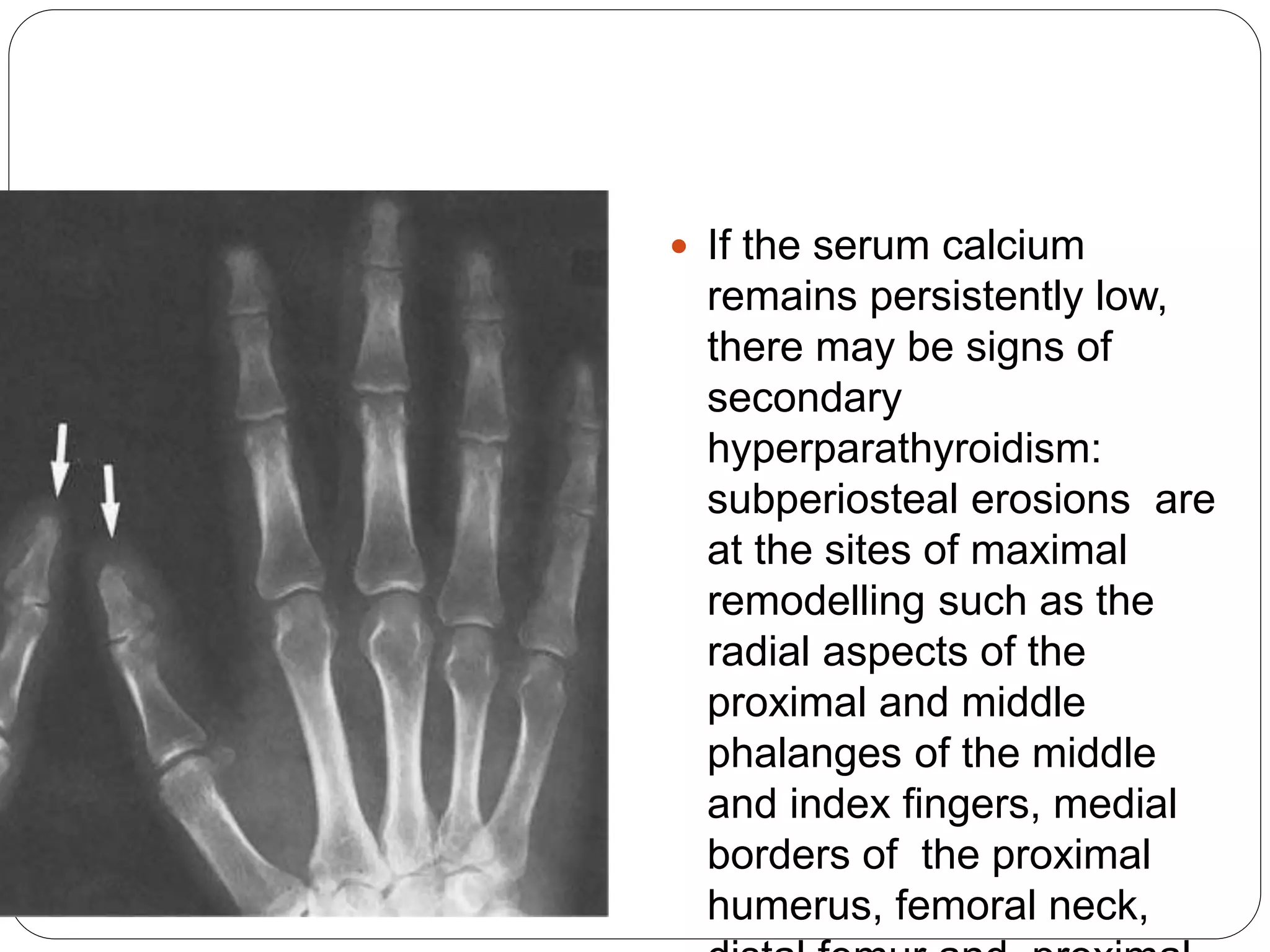 Rickets & osteomalacia | PPTX