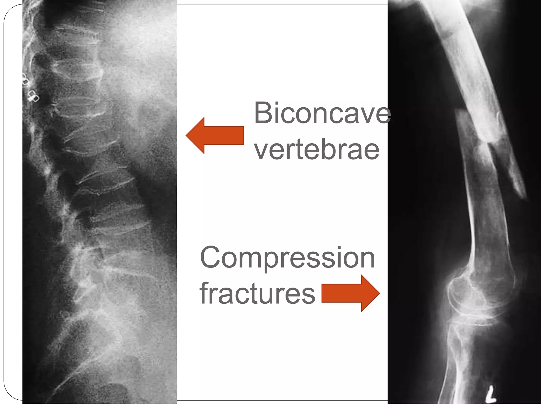Rickets & osteomalacia | PPTX