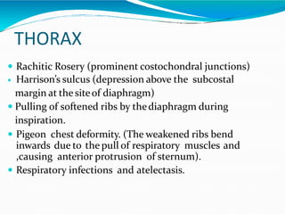 Rickets & osteomalacia | PPTX