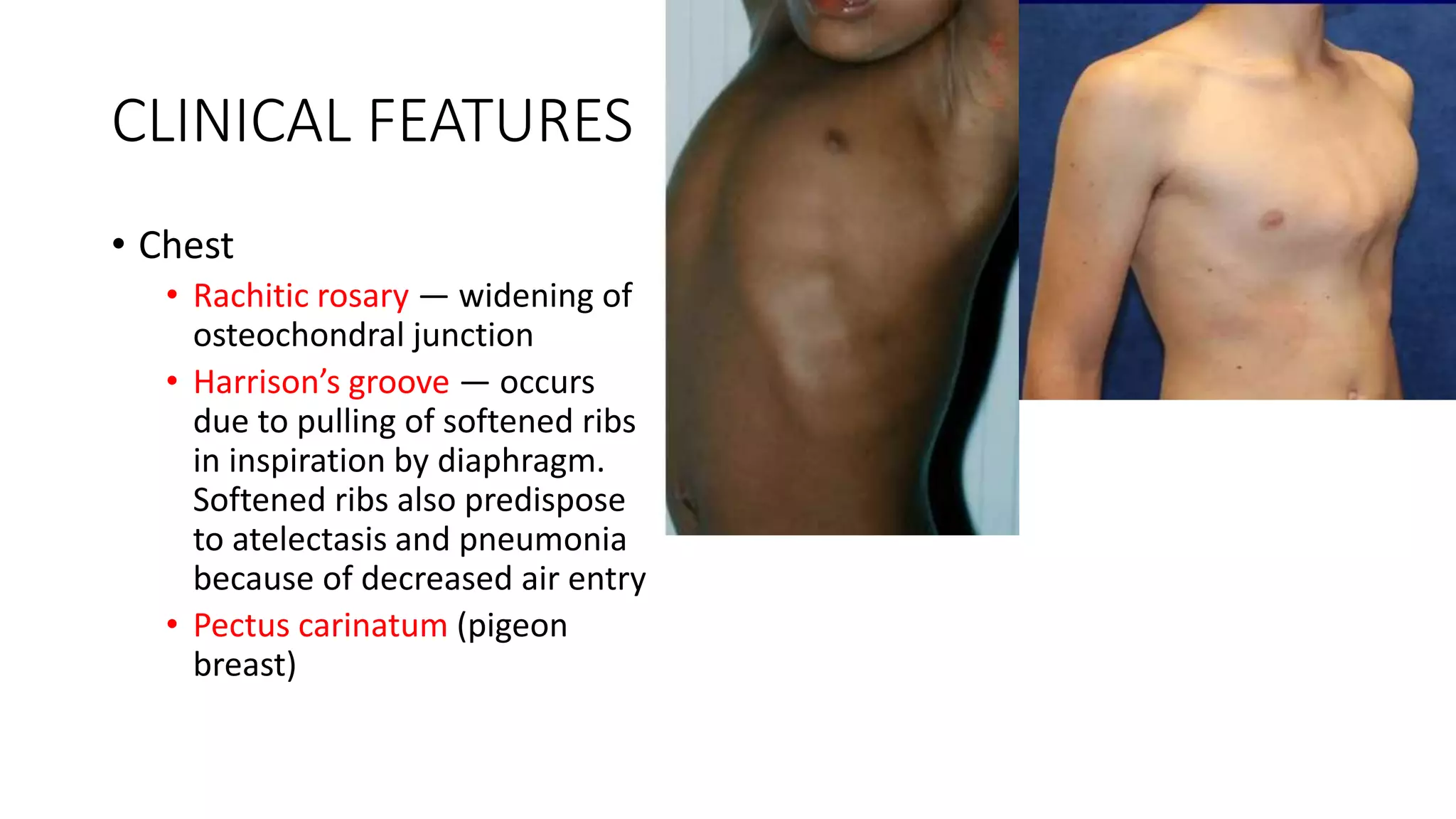 Rickets & Osteomalacia.pptx