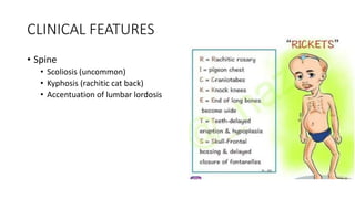 CLINICAL FEATURES
• Spine
• Scoliosis (uncommon)
• Kyphosis (rachitic cat back)
• Accentuation of lumbar lordosis
 