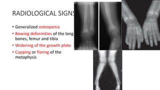 RADIOLOGICAL SIGNS
• Generalized osteopenia
• Bowing deformities of the long
bones, femur and tibia
• Widening of the growth plate
• Cupping or flaring of the
metaphysis
 