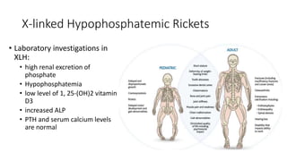 X-linked Hypophosphatemic Rickets
• Laboratory investigations in
XLH:
• high renal excretion of
phosphate
• Hypophosphatemia
• low level of 1, 25-(OH)2 vitamin
D3
• increased ALP
• PTH and serum calcium levels
are normal
 
