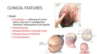 CLINICAL FEATURES
• Head:
• Craniotabes — softening of cranial
bones. also seen in osteogenesis
imperfect, hydrocephalus and syphilis
• Frontal bossing
• Delayed dentition and tooth caries
• Delayed closure of fontanel
• Craniosynostosis.
 