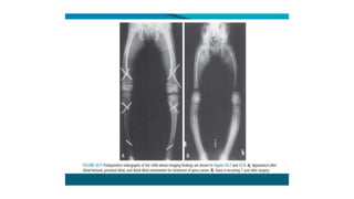 RICKETS & OSTEOMALACIA.pptx