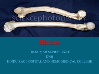 Rickets
DR.KUMAR SUPRASHANT
DNB
HINDU RAO HOSPITAL AND NDMC MEDICAL COLLEGE
 