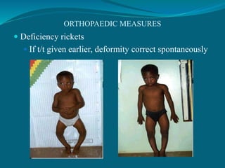 ORTHOPAEDIC MEASURES
 Deficiency rickets
 If t/t given earlier, deformity correct spontaneously
 