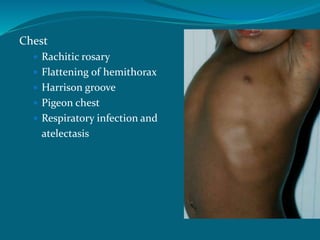 Chest
 Rachitic rosary
 Flattening of hemithorax
 Harrison groove
 Pigeon chest
 Respiratory infection and
atelectasis
 