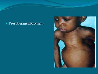  Protuberant abdomen
 
