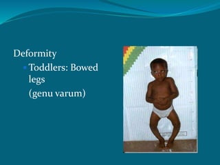 Deformity
 Toddlers: Bowed
legs
(genu varum)
 