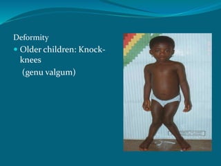 Deformity
 Older children: Knock-
knees
(genu valgum)
 