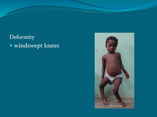 Deformity
 windswept knees
 