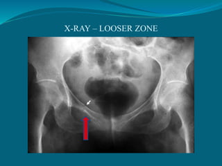 X-RAY – LOOSER ZONE
 