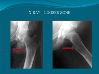 X-RAY – LOOSER ZONE
 