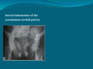 lateral indentation of the
acetabulam (trefoil pelvis)
 