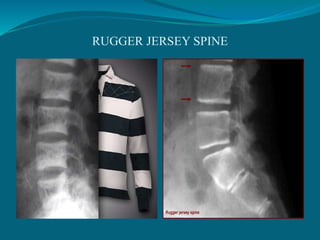 RUGGER JERSEY SPINE
 