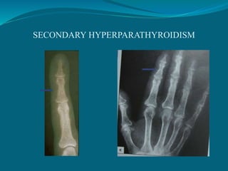 SECONDARY HYPERPARATHYROIDISM
 