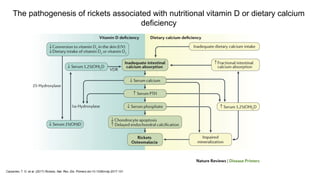 Calcium Rickets Comprehensive Overview of Rickets: Causes, Diagnosis, and Treatment | PPTX