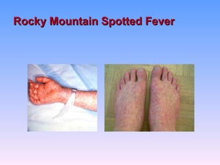 Rocky Mountain Spotted Fever
 