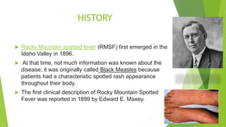 HISTORY
 Rocky Mountain spotted fever (RMSF) first emerged in the
Idaho Valley in 1896.
 At that time, not much information was known about the
disease; it was originally called Black Measles because
patients had a characteristic spotted rash appearance
throughout their body.
 The first clinical description of Rocky Mountain Spotted
Fever was reported in 1899 by Edward E. Maxey.
 