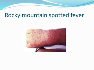 Rocky mountain spotted fever
 
