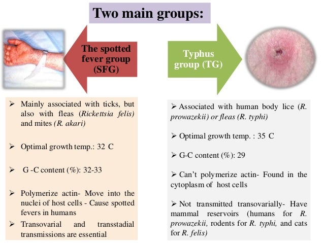 typhus fever