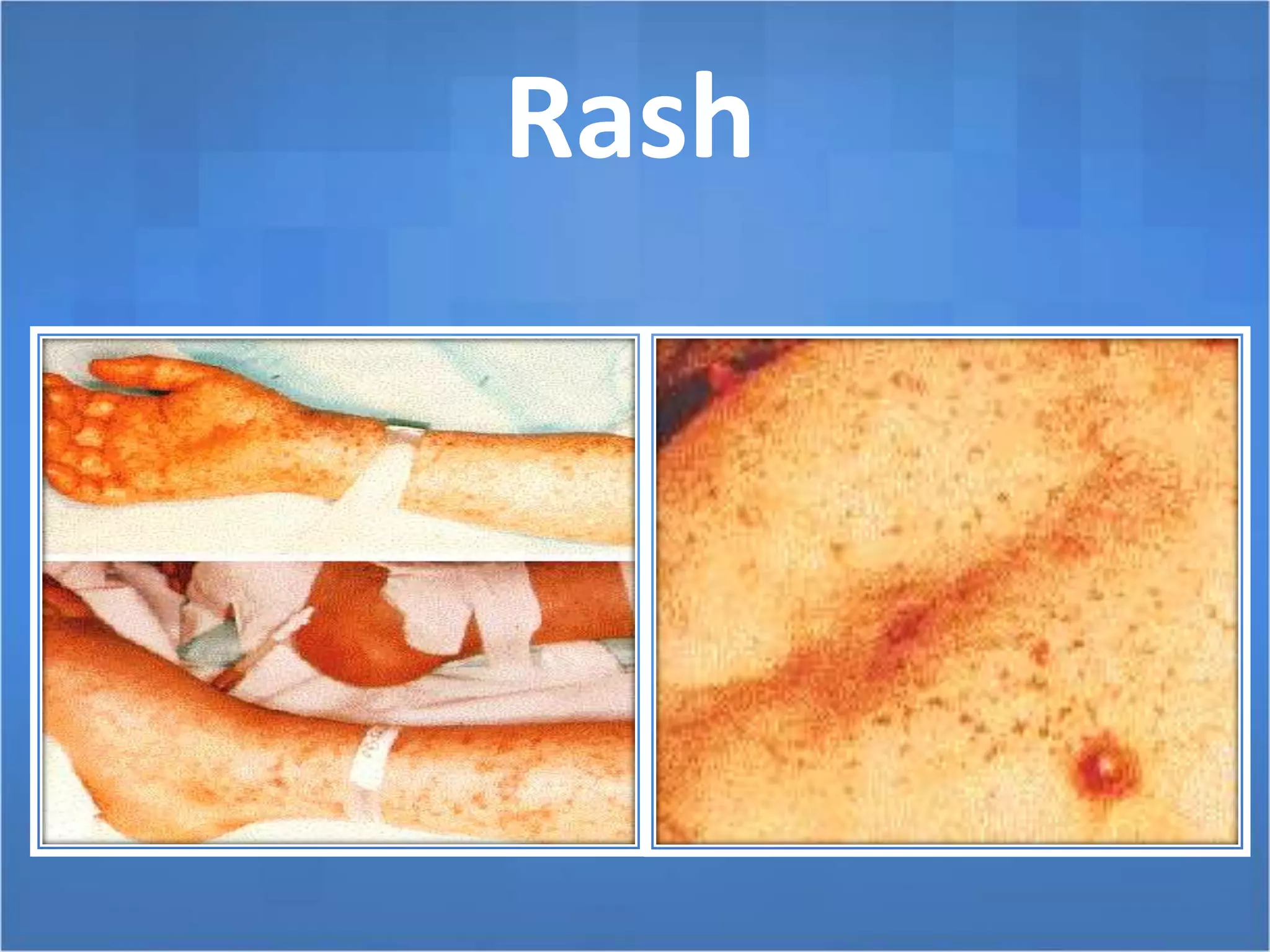 Ricketta Rash Rickettsial diseases | PPTX