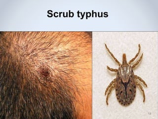 Scrub typhus
17 Feb 2016 13
 