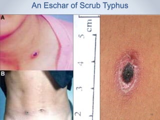 An Eschar of Scrub Typhus
17 Feb 2016 19
 