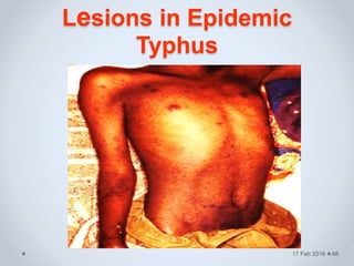Lesions in Epidemic
Typhus
17 Feb 2016 48
 