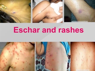 Rickettsial fever | PPTX