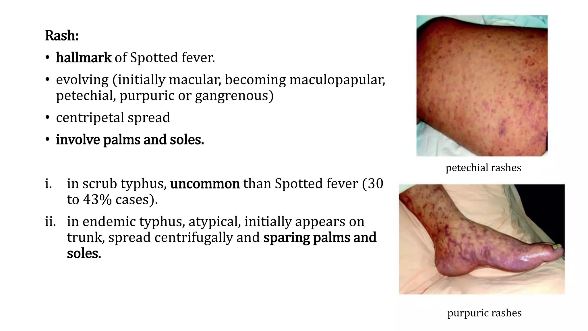 Rickettsial Infection.pptx
